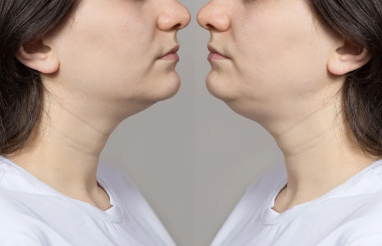 Antes e depois do tratamento de seca papada na Clínica Essencial Estética, destacando a definição do contorno facial