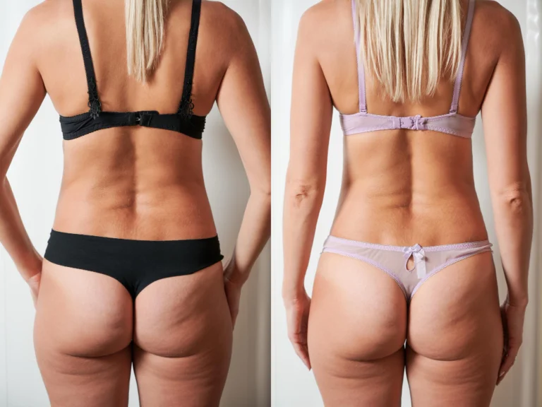 Antes e depois do tratamento Xô Celulite na Clínica Essencial Estética, mostrando a redução de celulite e melhora da firmeza