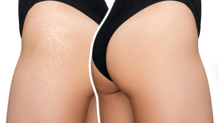 "Antes e depois do tratamento Xô Estrias na Clínica Essencial Estética, destacando a suavização das estrias