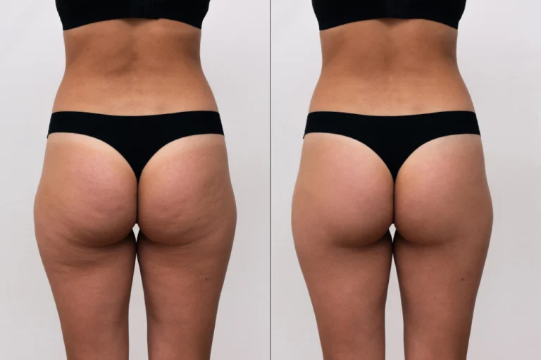 Antes e depois do tratamento de Carboxiterapia na Clínica Essencial Estética, mostrando a redução de celulite e melhora na firmeza da pele.