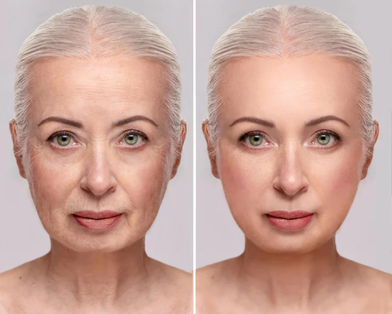 Antes e depois do tratamento com fios de sustentação na Clínica Essencial Estética, mostrando a elevação e definição dos contornos faciais