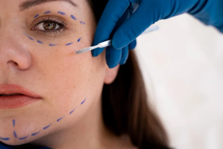 Profissional aplicando fios de sustentação no rosto de uma paciente na Clínica Essencial Estética