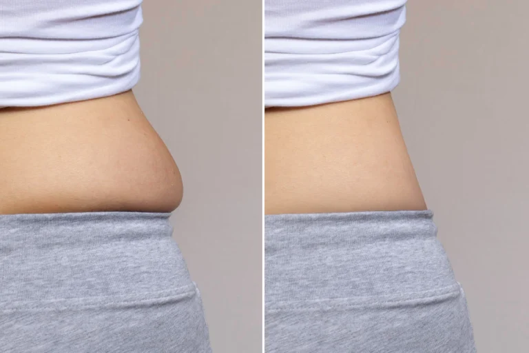 Antes e depois do tratamento de Lipo Enzimática no abdômen na Clínica Essencial Estética, mostrando a redução de medidas e definição corporal.