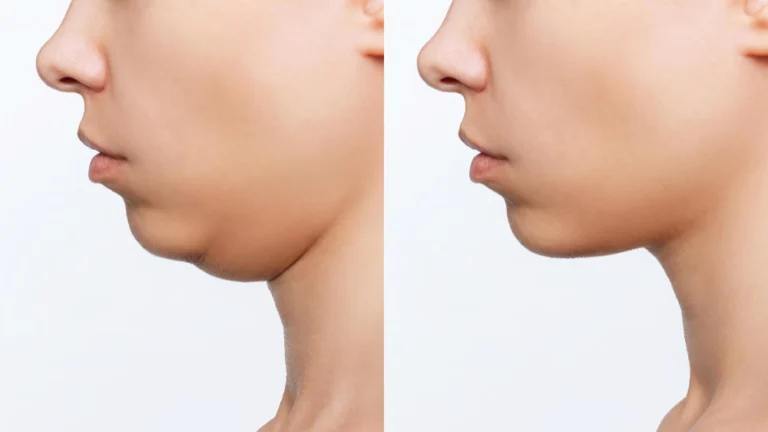 Antes e depois do tratamento de Lipo de Papada na Clínica Essencial Estética, mostrando a redução da papada e contorno facial definido