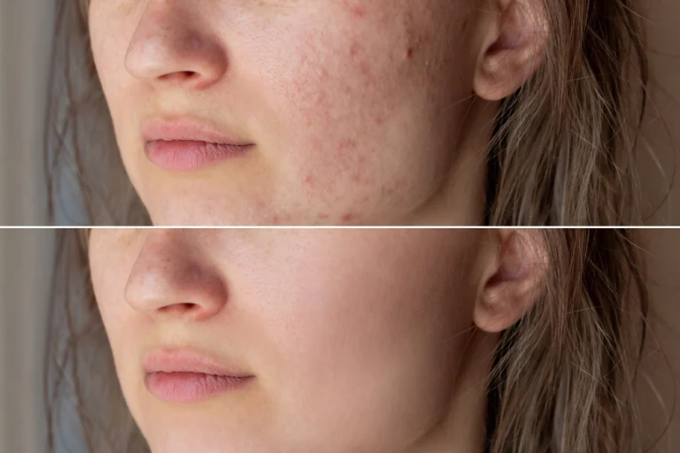 Antes e depois do tratamento para acne ativa, mostrando a redução das espinhas e inflamações.