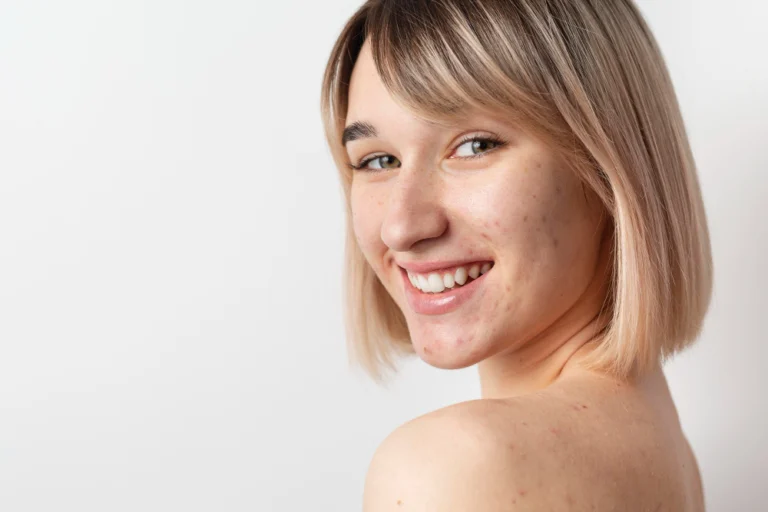 Mulher jovem com pele saudável e limpa após tratamento para acne ativa