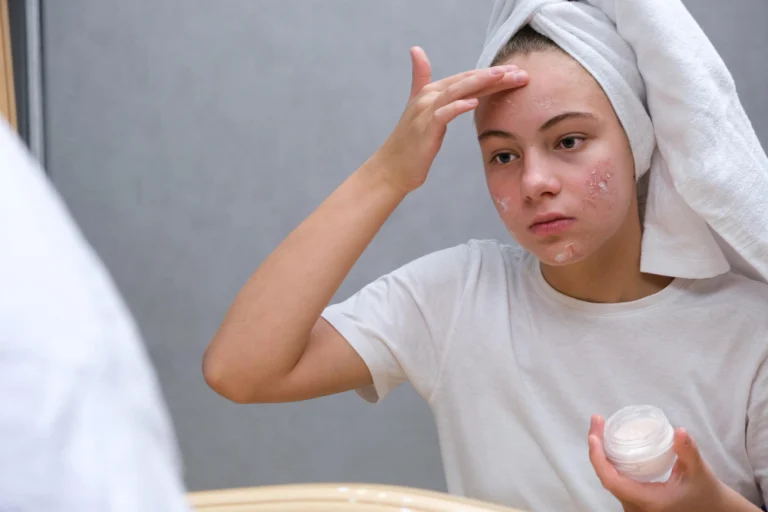 Paciente aplicando protetor solar após tratamento para acne ativa