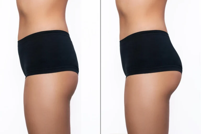 Antes e depois do tratamento Bumbum na Nuca, mostrando elevação e firmeza dos glúteos.