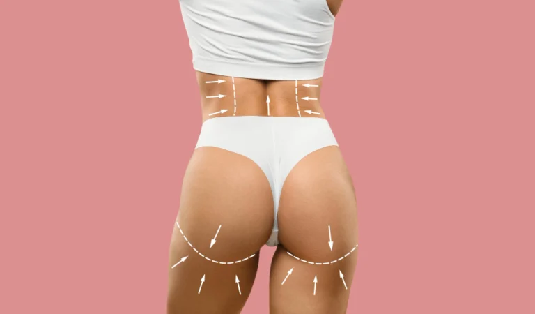 Mulher com silhueta harmoniosa e glúteos elevados após o tratamento Bumbum na Nuca.