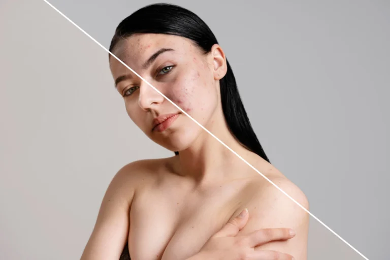 Antes e depois do microagulhamento com drug delivery na Clínica Essencial Estética, destacando a melhora na textura e redução de manchas