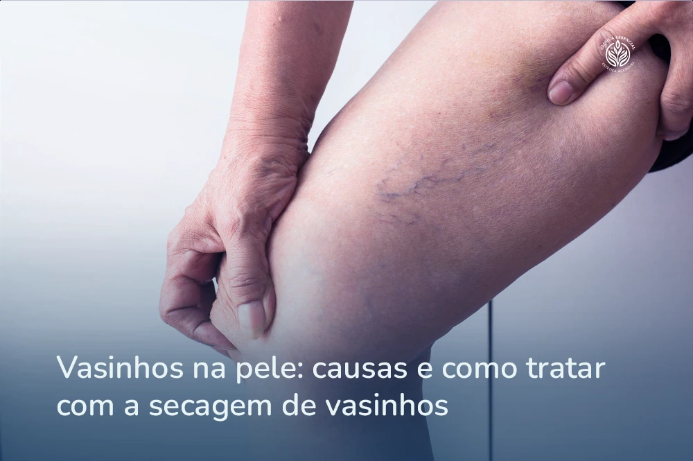 Tratamento para secagem de vasinhos na Clínica Essencial Estética