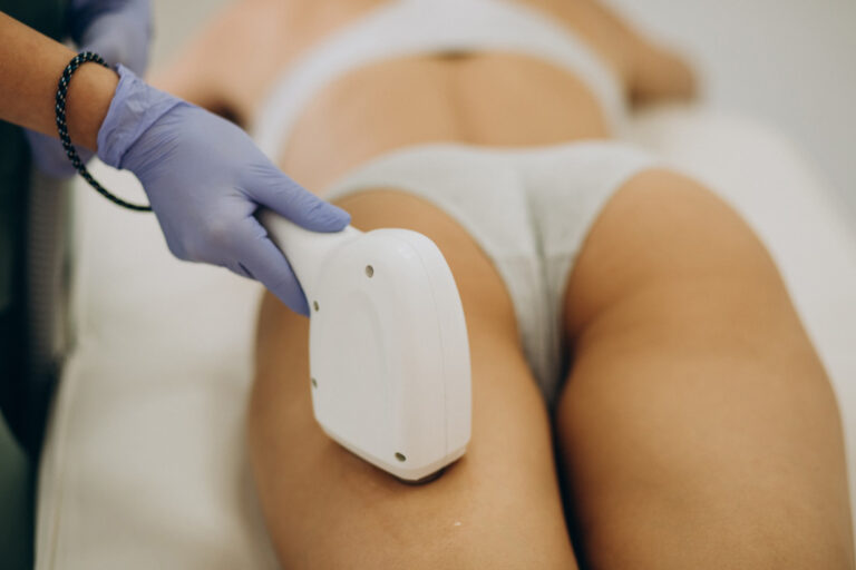 Mulher recebendo tratamento estético para estrias com microagulhamento na Clínica Essencial Estética